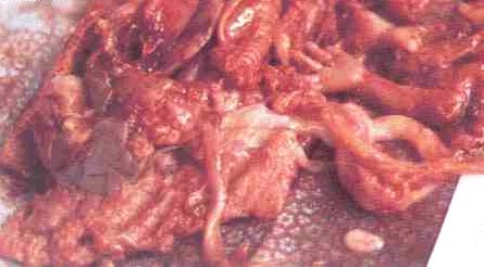  Aborto eseguito con ferri a 10 settimane 